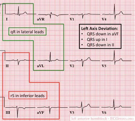 ecg porn|Ecg Porn